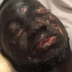 #Woman Arrested for Acid Attack on Ex-Boyfriend in Accra